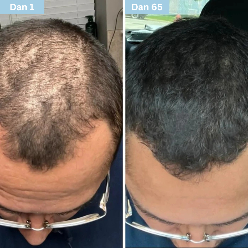 Daynava™ Roll-On za rast kose